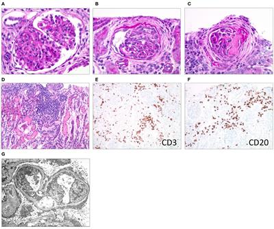 Case Report: CMV-Associated Congenital Nephrotic Syndrome